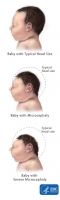 St Maarten ta confirma sospecho di prome caso di baby cu microcephaly