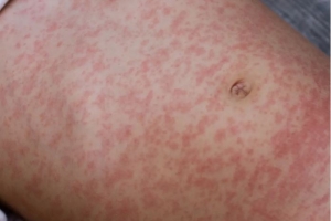 DVG ta splica e señal y sintomanan di measles (sarampi)