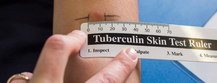 DVG: Falta hende cu mester haci test di Tuberculosis e siman aki   