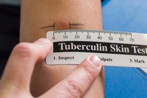 DVG: Falta hende cu mester haci test di Tuberculosis e siman aki   