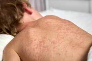 DVG: Con Measles (sarampi) ta transmiti su mes